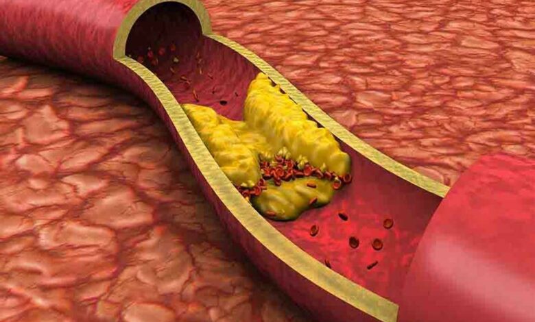 "Triglycerides