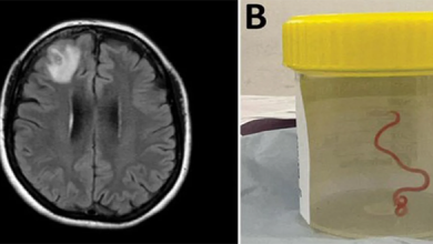 أطباء أستراليون يستخرجون دودة طفيلية من دماغ امرأة