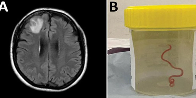 أطباء أستراليون يستخرجون دودة طفيلية من دماغ امرأة